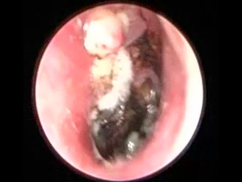 Severe Fungal Ear Infection cleaning by suction irrigation